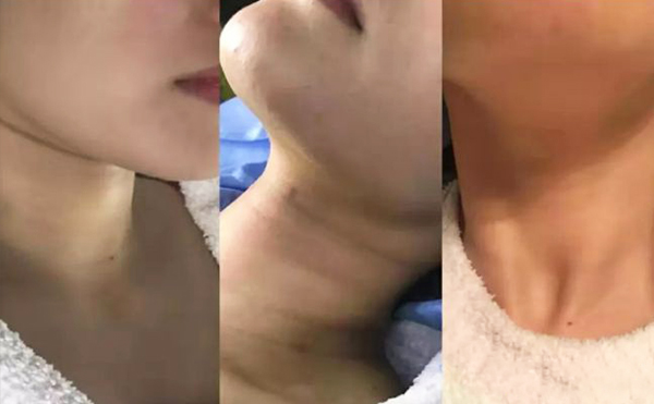 激光去頸紋多少錢？