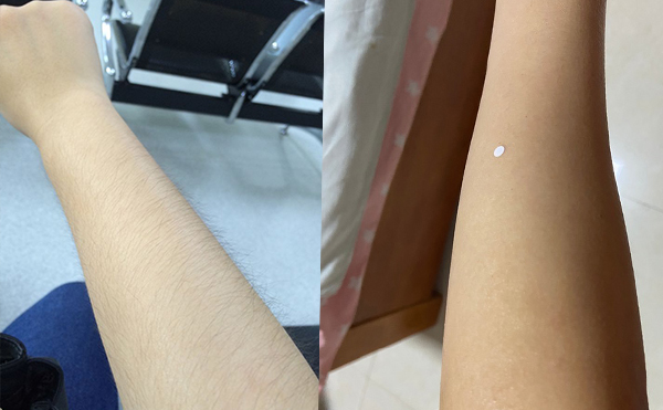 激光手臂脫毛價(jià)格貴不貴？