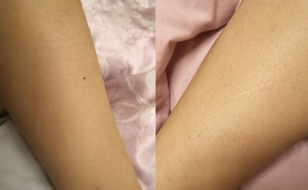 冰點脫腿毛幾次有效?有什么優(yōu)勢?