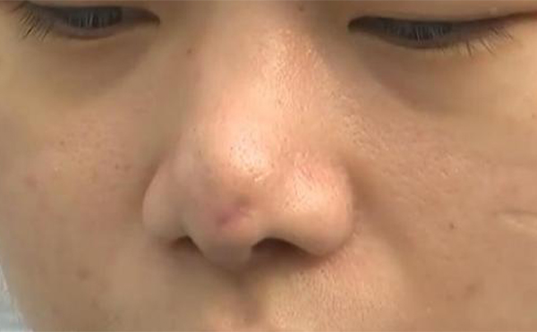 如果更換隆鼻假體，當天可以直接換嗎?