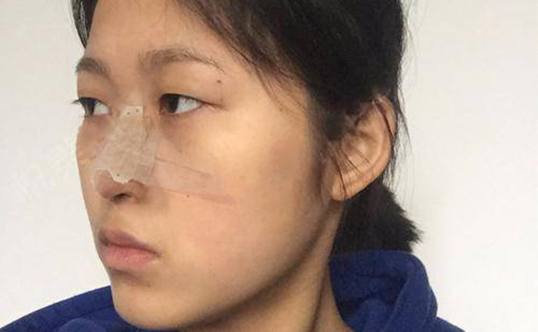 北京隆鼻失敗修復(fù)多少錢?哪家好?