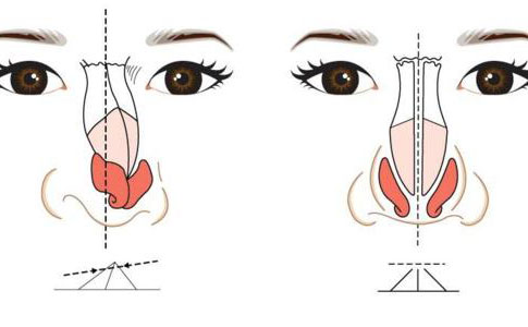 歪鼻矯正手術(shù)大概多少錢？歪鼻矯正手術(shù)成功率為多少？