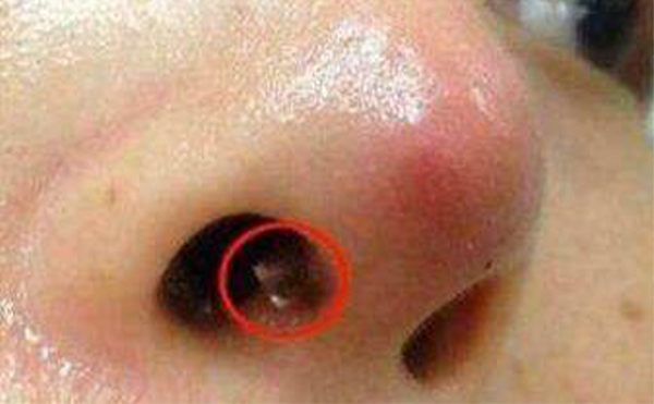 蕪湖伊萊美隆鼻失敗修復(fù)需要費用嗎?