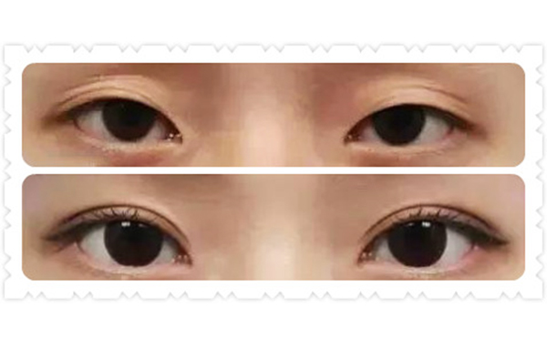 那雙眼皮變多眼皮怎么辦?如何改善多眼皮?