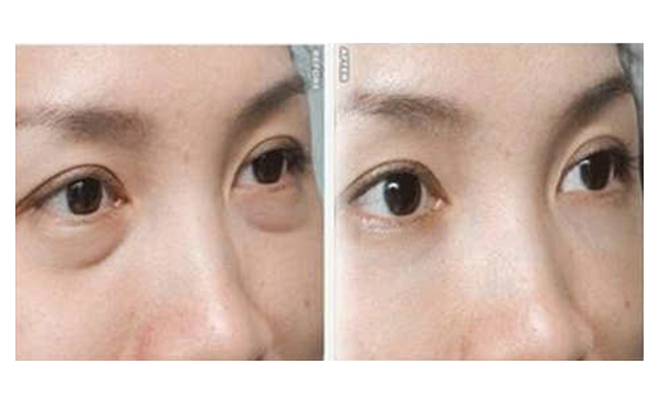 吸脂去眼袋有什么優(yōu)勢？