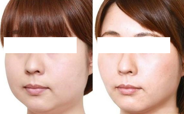 面部吸脂術(shù)適合哪些人群？