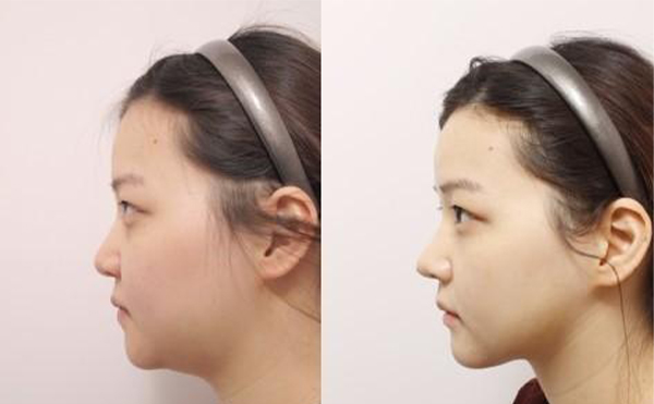 五類建議做下巴整形的下巴，快看看有沒有你