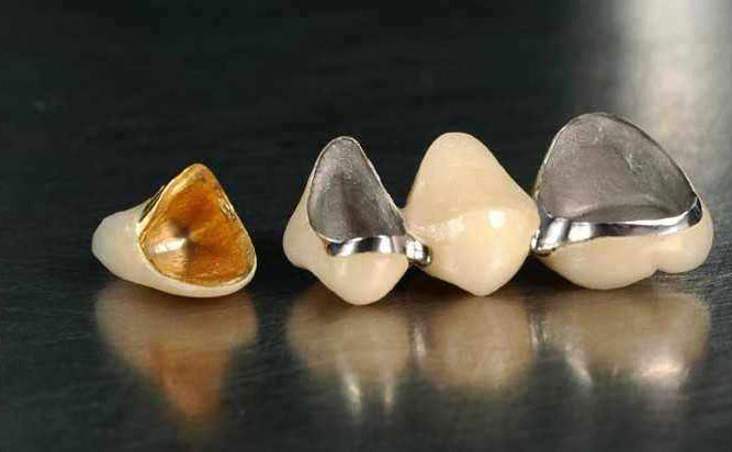 貴金屬烤瓷牙多少錢一顆？