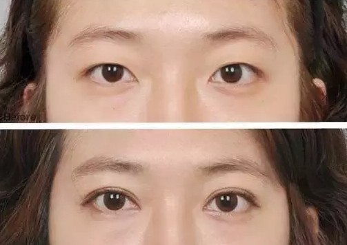 兩眼睛距離過寬