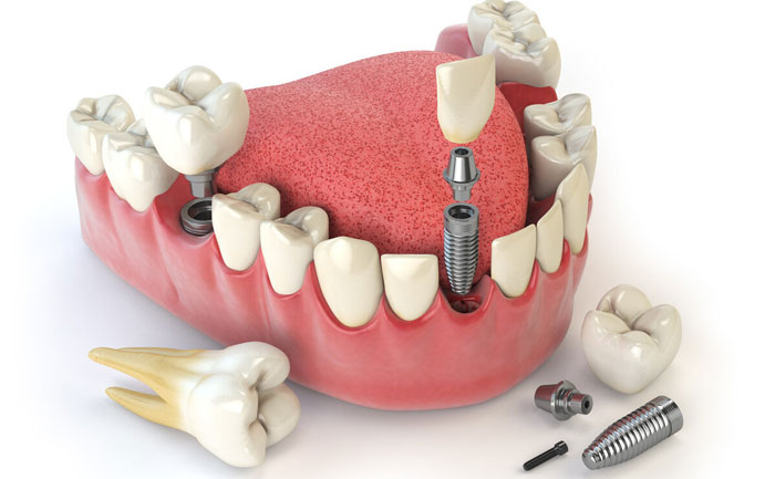 植牙多少錢一顆，植牙的種植體哪種好？