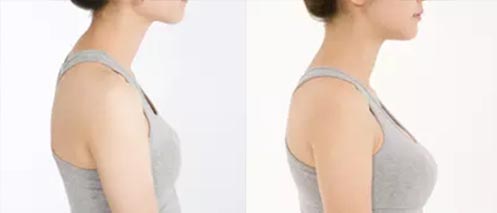 假體隆胸手術(shù)效果對比圖1