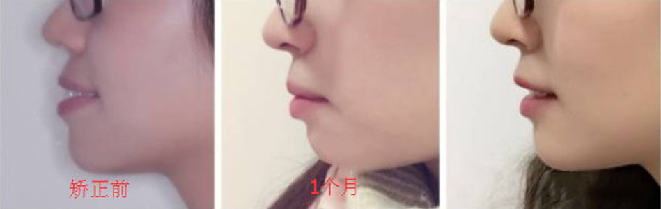 牙齒矯正前后效果對(duì)比圖