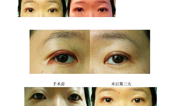 開外眼角和眼瞼下至的區(qū)別是什么?多久恢復(fù)好?