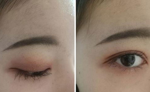 割雙眼皮的危害是什么？