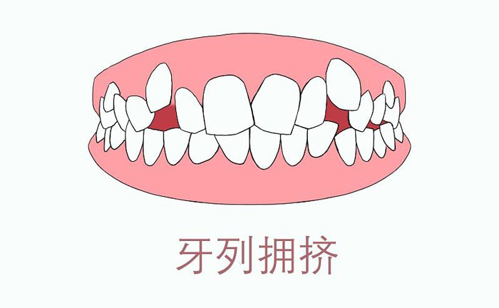 矯正牙齒擁擠度怎么算？