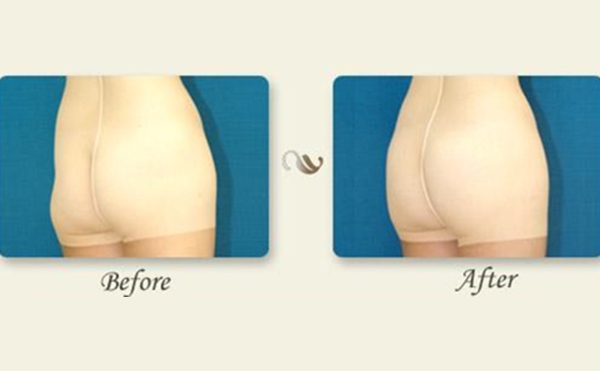 做自體脂肪豐臀與季節(jié)有關(guān)系嗎?豐臀失敗修復(fù)效果怎么樣?