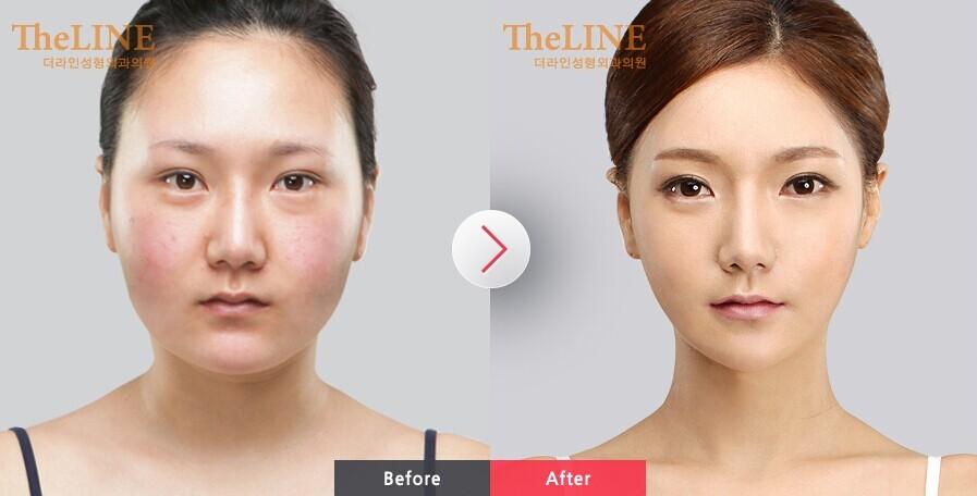 削臉頰骨需要多少錢？削臉頰骨成功率高嗎？