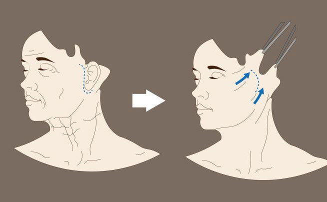 電波拉皮一次大概多少錢？