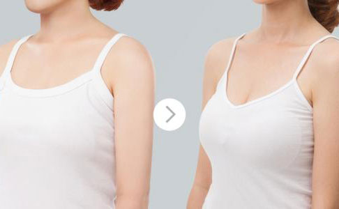 假體隆胸的費(fèi)用是多少？