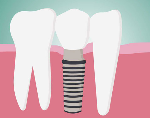 牙齒修復(fù)多少錢(qián)一顆？