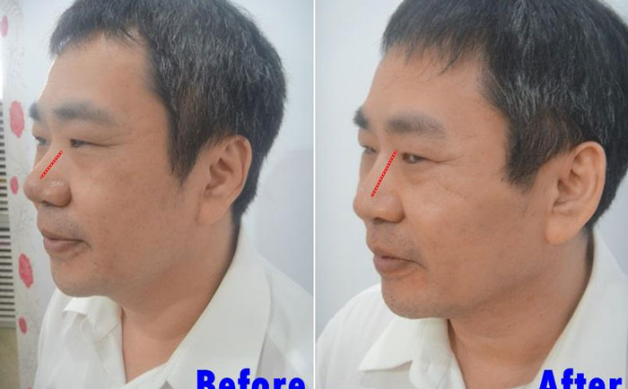 男性隆鼻子大概多少錢？