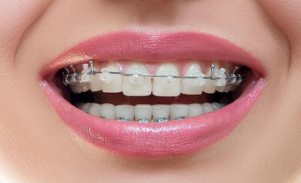 齙牙矯正最快的方法？