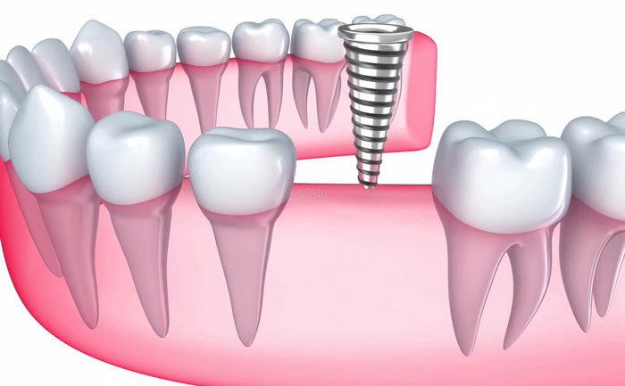牙齒種植大概費(fèi)用是多少？牙齒種植多少錢一顆