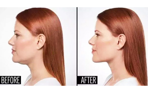 超聲波面部吸脂的過程是什么？