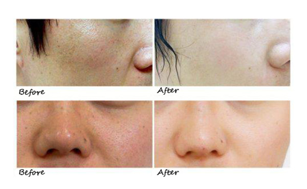 水光針的效果怎么樣？