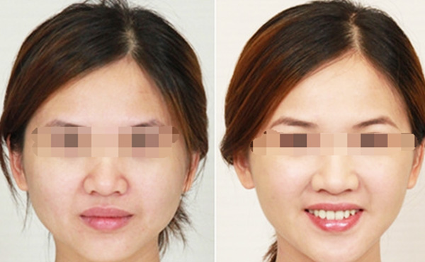瘦臉針的效果怎么樣？