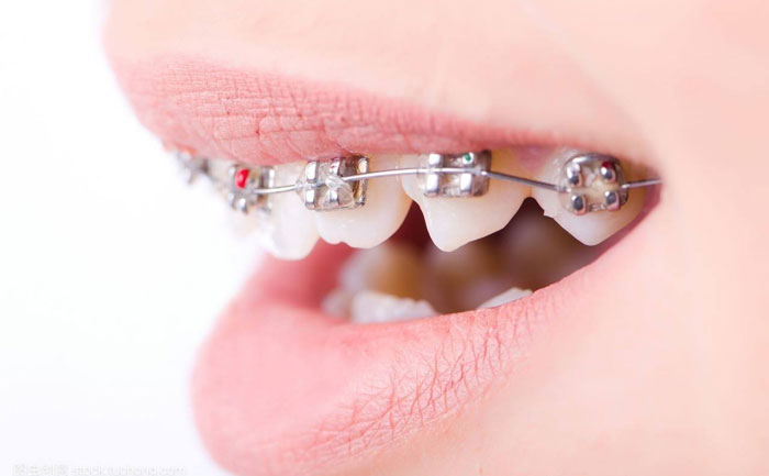 口腔正畸的最佳治療方法？口腔正畸的最佳年齡是多少？