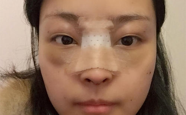 隆鼻修復(fù)手術(shù)一般多少錢?