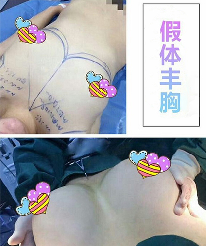 假體豐胸手術(shù)效果圖