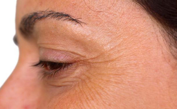 眼角紋怎么消除簡單方法？眼角紋去除要多少錢？