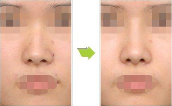 歪鼻矯正手術(shù)是怎么做的?安全嗎?