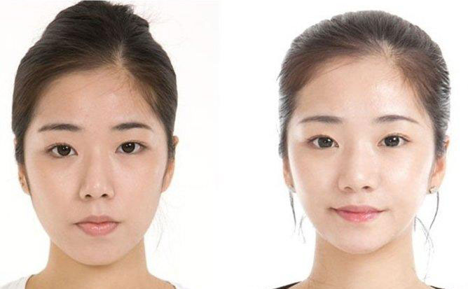 面部吸脂瘦臉的副作用？