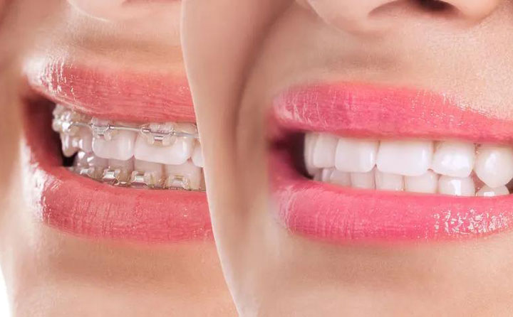 齙牙矯正大概需要花費多少錢？齙牙矯正可以改善凸嘴嗎？