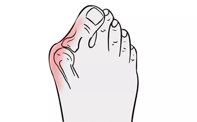 大腳骨矯正手術(shù)多少錢？大腳骨矯正三個(gè)月可以恢復(fù)嗎？