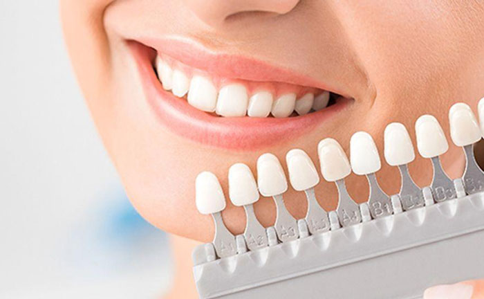 牙齒美白哪種方法好？