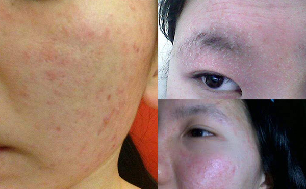 果酸煥膚有哪些風(fēng)險(xiǎn)和弊端？