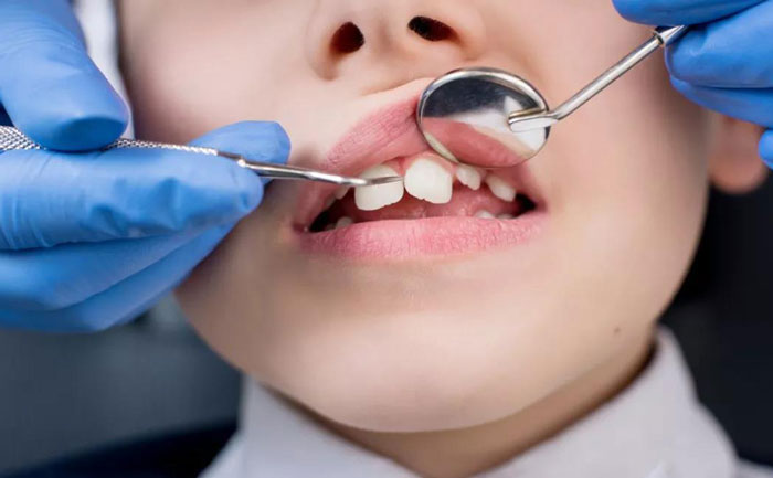 小孩牙齒矯正最佳年齡？小孩牙齒矯正價格多少錢？