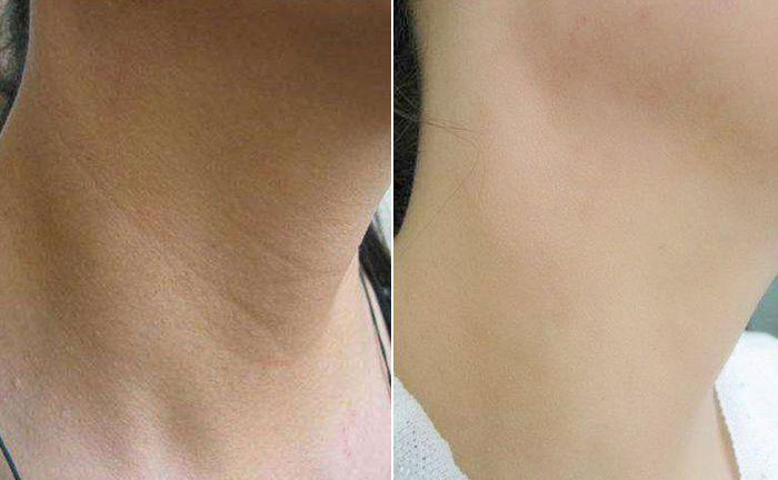 嗨體去頸紋效果怎么樣？