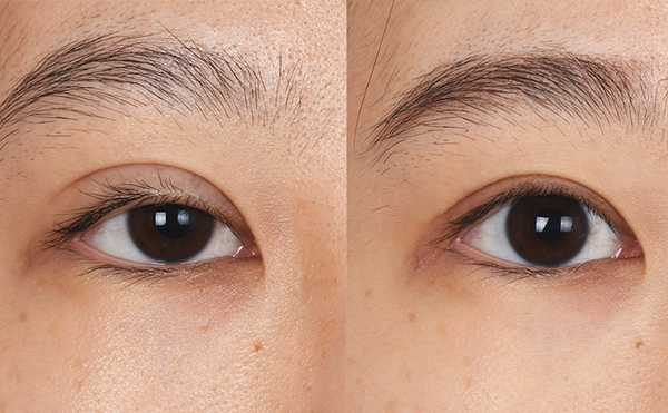 眼部修復(fù)風(fēng)險(xiǎn)大嗎？眼修復(fù)價(jià)格是多少？