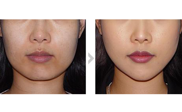 面部吸脂可以多次進(jìn)行嗎？