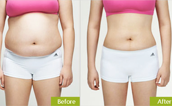 腰腹吸脂有什么優(yōu)勢？