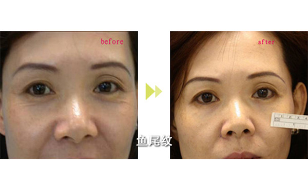 光子嫩膚去除魚尾紋安全嗎?多少錢?