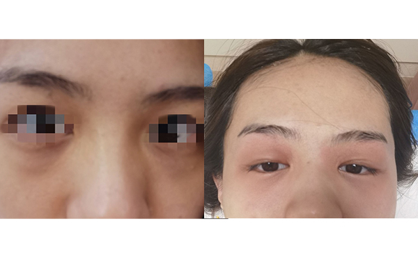 光子嫩膚去黑眼圈怎么樣？