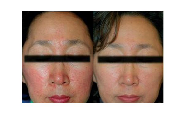 復(fù)合彩光去紅血絲痛不痛？