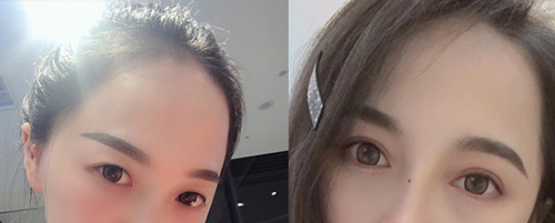 蘭州亞韓做雙眼皮案例對比圖1