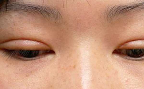 埋線雙眼皮失敗該如何修復(fù)？多久修復(fù)好？